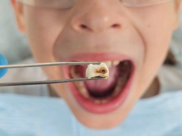Best Emergency Dental Care for Broken or Chipped Teeth in Canyon Day, AZ